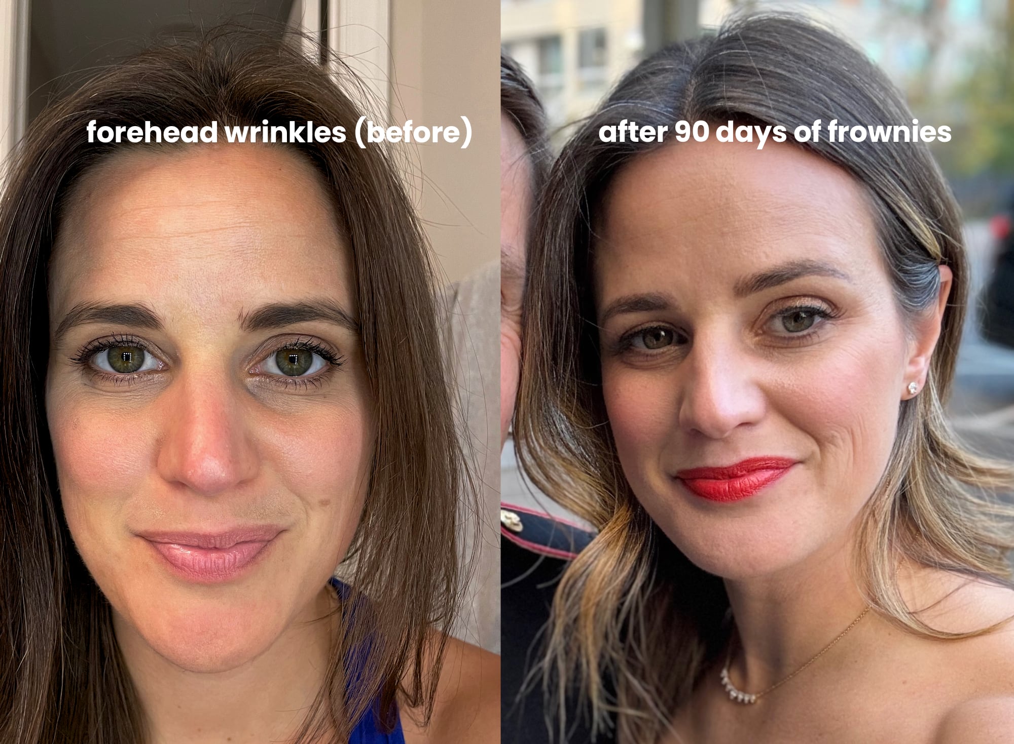 A step by step guide for how to apply Frownies facial patches to stop forehead wrinkles.